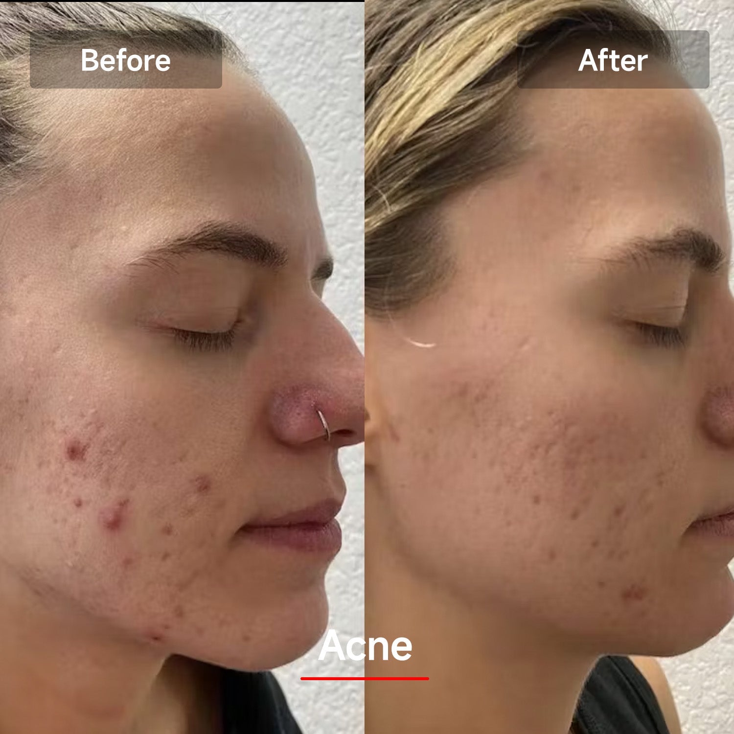 Megelin LED Red Light Therapy Face Mask