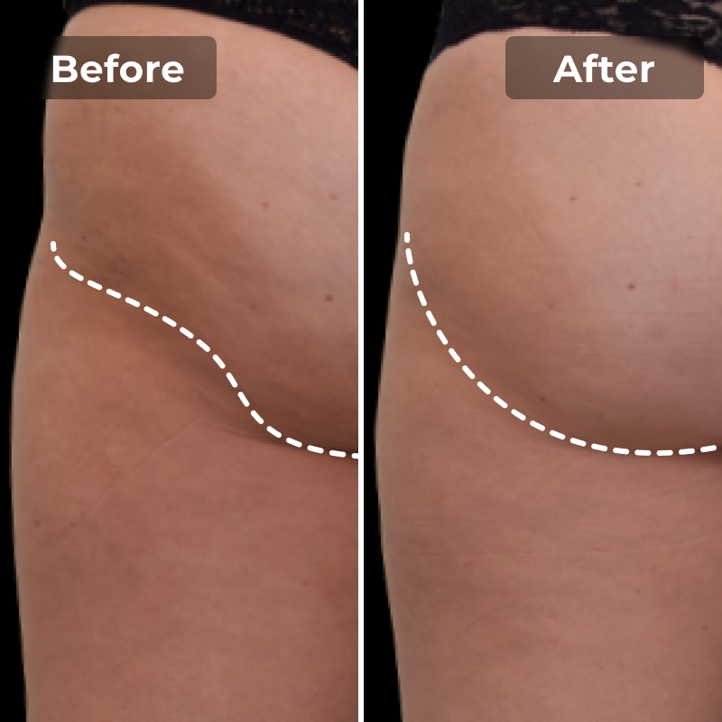 Megelin EMS Toning Shorts